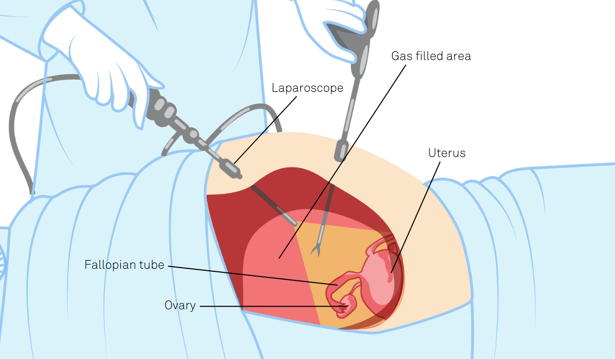 Gas filled area 1