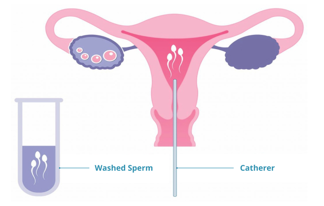 Infertility & IVF Treatment in Mathura