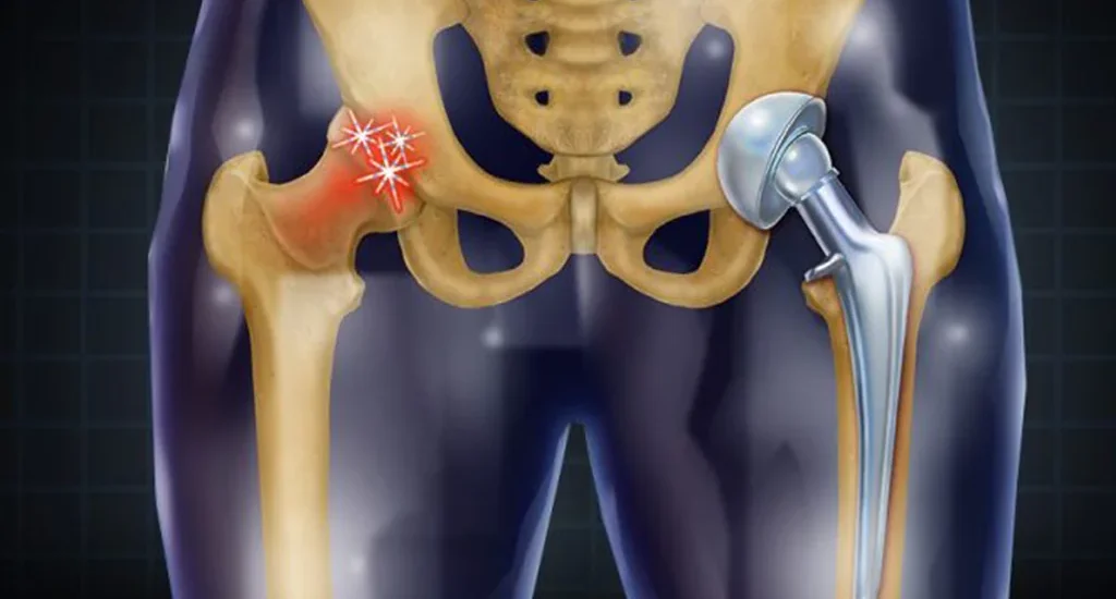 Everything You Need To Know About Minimally Invasive Total Hip Replacement