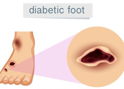 human foot with diabetic 1308 16180