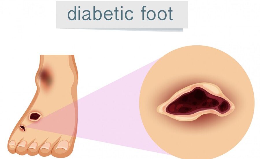 human foot with diabetic 1308 16180