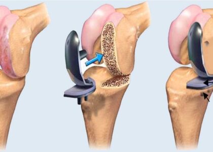 knee replacement surgery noida