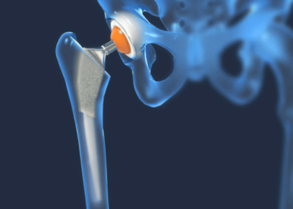 Hip Replacement Recovery
