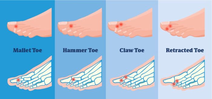 Toe Deformities Treatment in Mathura - Dr Swapnil Verman