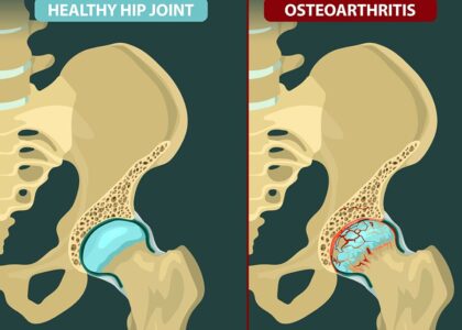 Hip Osteoarthritis Treatment Without Surgery in Mathura