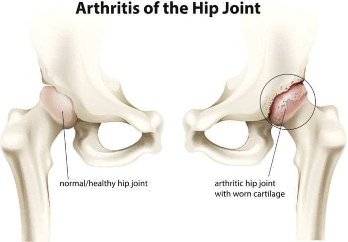 non surgical treatment for hip osteoarthritis