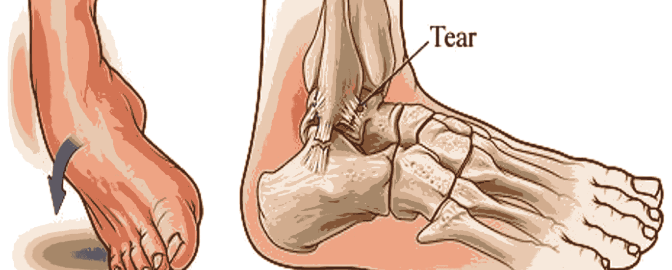 Ankle Sprains Treatment in Mathura