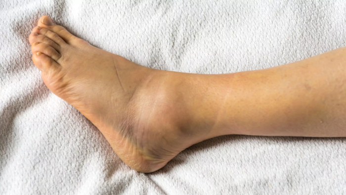 Ankle Sprains Treatment in Mathura