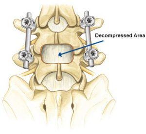 Spinal Decompression Surgery in Mathura