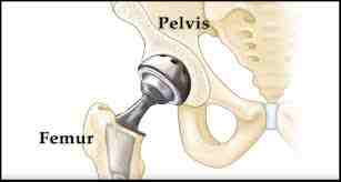 Hip Avascular Necrosis Treatment in Mathura 
