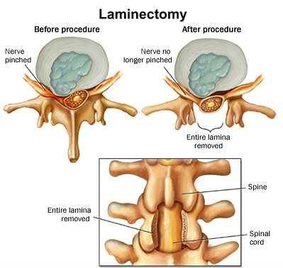 Spinal Decompression Surgery in Mathura