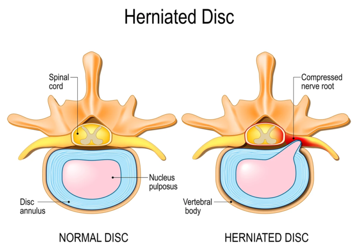 Spine Surgery in Mathura