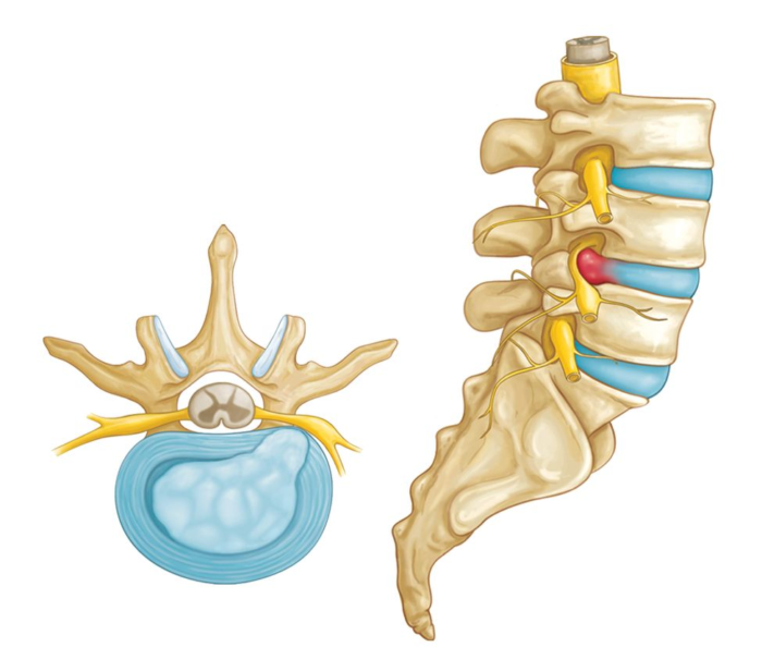 Spine Surgery in Mathura
