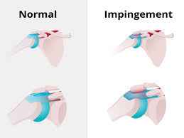 shoulder impingement syndrome treatment in mathura 
