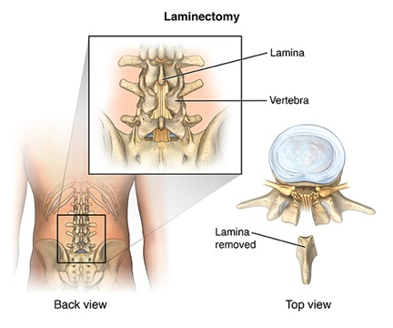 Lumbar Stenosis Treatment in Mathura