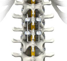 Lumbar Stenosis Treatment in Mathura