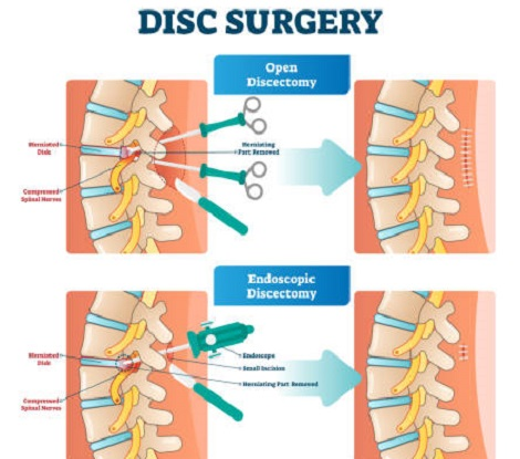 Lumbar Stenosis Treatment in Mathura