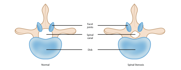 Lumbar Stenosis Treatment in Mathura