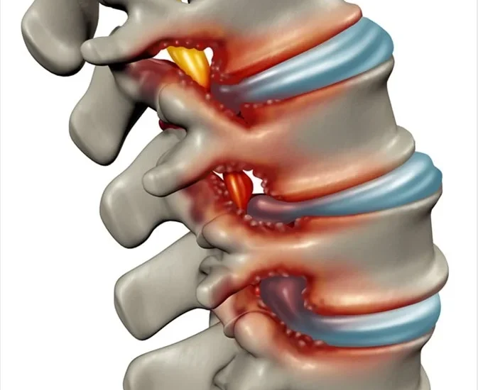 Lumbar Stenosis Treatment in Mathura