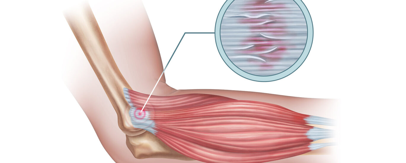 Tennis Elbow Treatment in Mathura