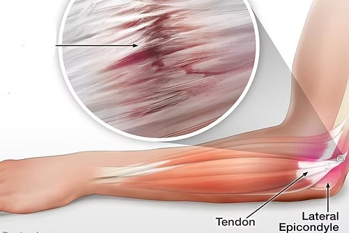 Tennis Elbow Treatment in Mathura