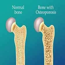 osteoporosis treatment in mathura 
