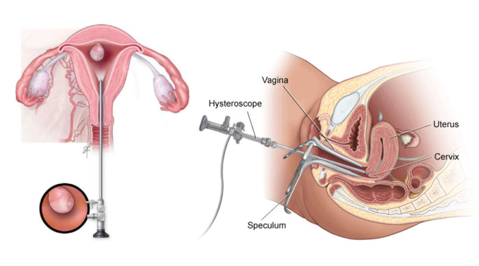 Hysteroscopy Surgery In Mathura