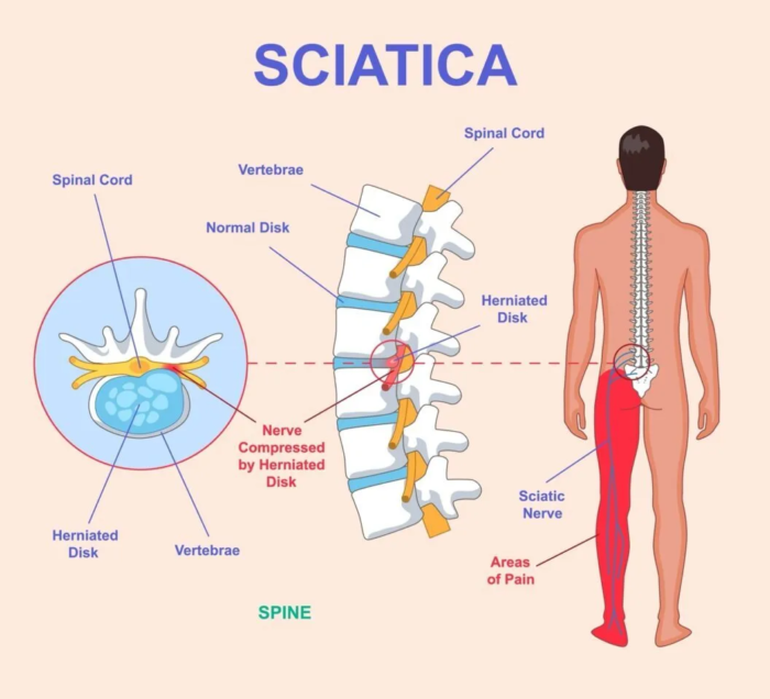 Slipped Disc & Sciatica Treatment in Mathura