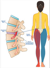 Slipped Disc & Sciatica Treatment in Mathura