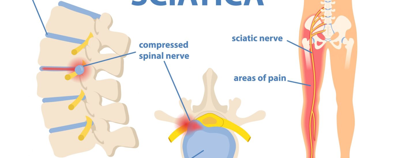 Slipped Disc & Sciatica Treatment in Mathura