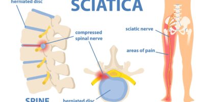 Slipped Disc & Sciatica Treatment in Mathura