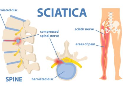 Slipped Disc & Sciatica Treatment in Mathura