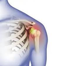 shoulder dislocation treatment in Mathura 
