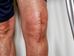 knee replacement in Mathura 