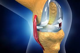 knee replacement in Mathura 