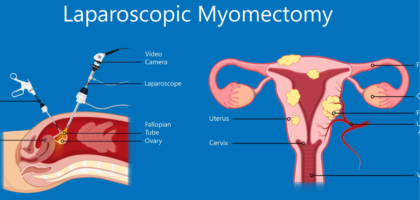 Fibroid Removal Treatment in Mathura