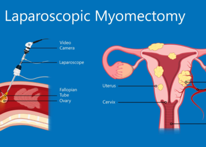 Fibroid Removal Treatment in Mathura
