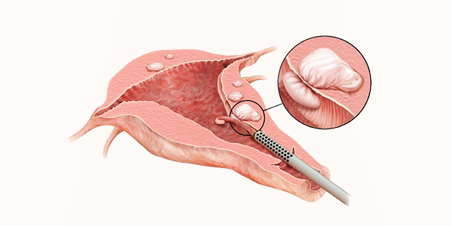 Fibroid Removal Treatment in Mathura