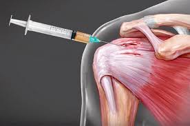 non-surgical joint pain treatment in Mathura 

