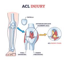 acl injury treatment in mathura 
