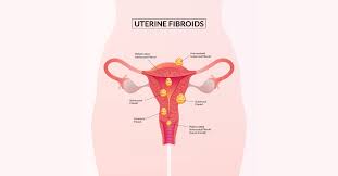 uterine fibroids treatment in Mathura