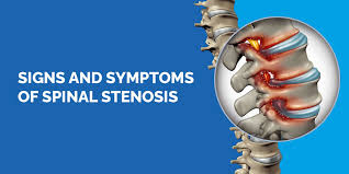 spinal stenosis treatment in Mathura 
