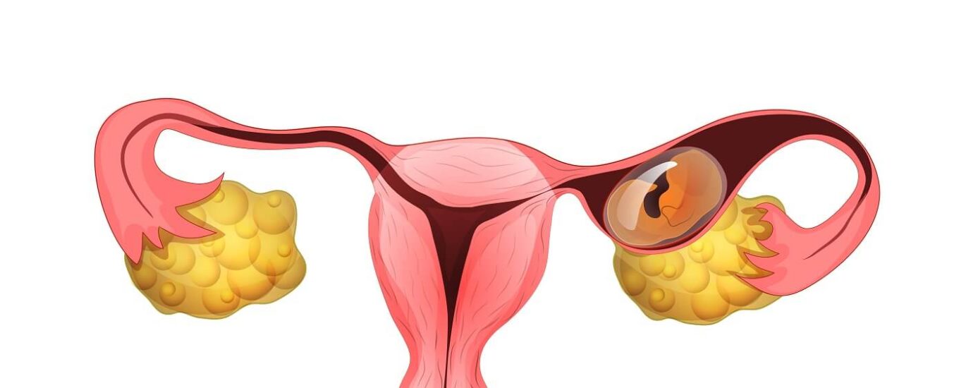 ectopic pregnancy treatment in mathura