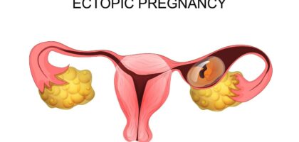 ectopic pregnancy treatment in mathura