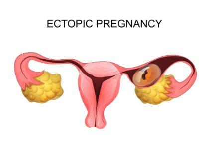 ectopic pregnancy treatment in mathura
