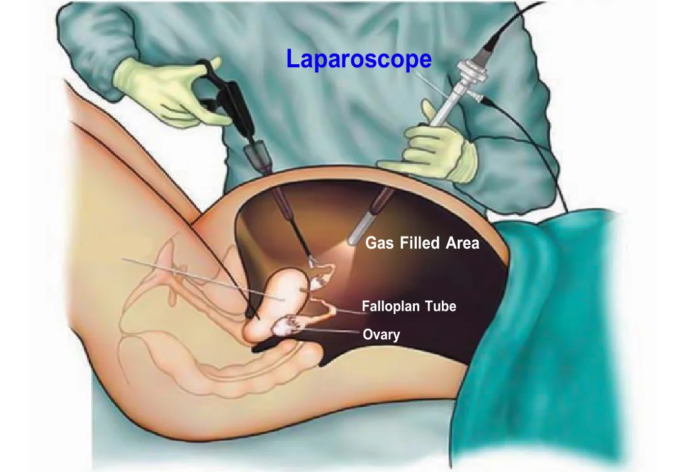 Ectopic Pregnancy Treatment in Mathura