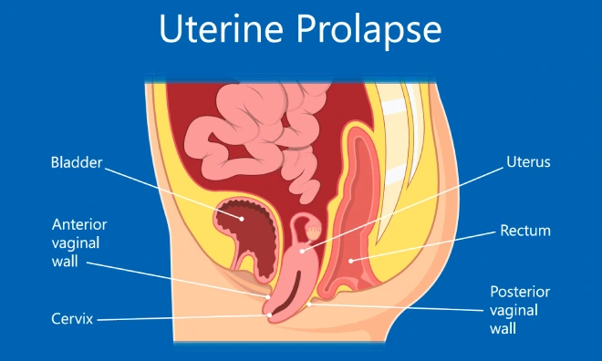 Uterin Prolapse