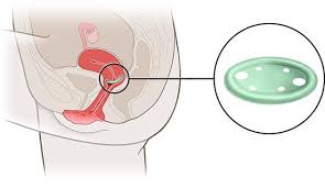 uterine prolapse treatment in Mathura 
