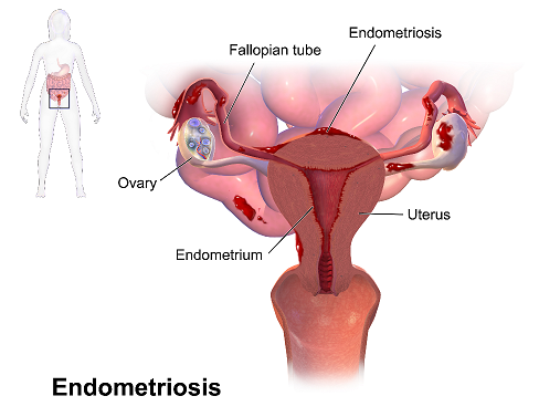 endometriosis surgical treatment in Mathura 
