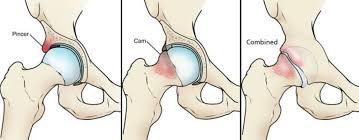 hip impingement treatment in Mathrua 
